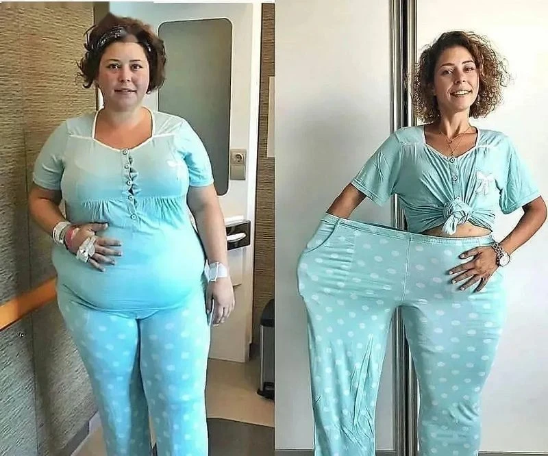 Post-weight-loss Body Shaping Treatment factory